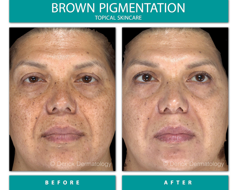 Before and After Image of Brown Pigmentation