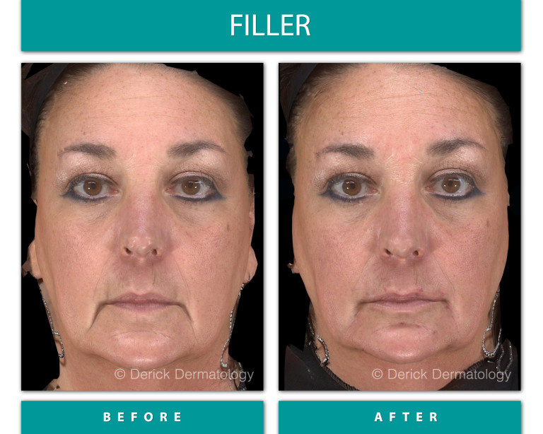 Before and After Image of Filler
