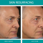 Before and After Image of Skin Resurfacing