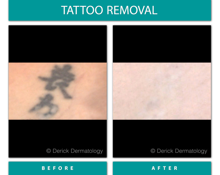 Before and After Image of Tattoo Removal