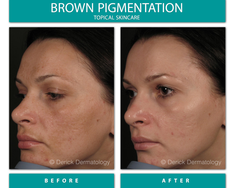 Before and After Image of Brown Pigmentation