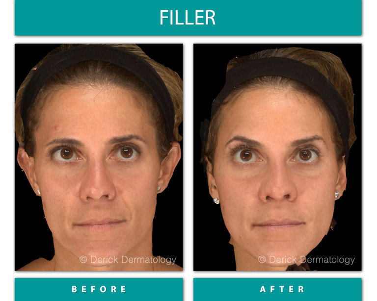 Before and After Image of Filler