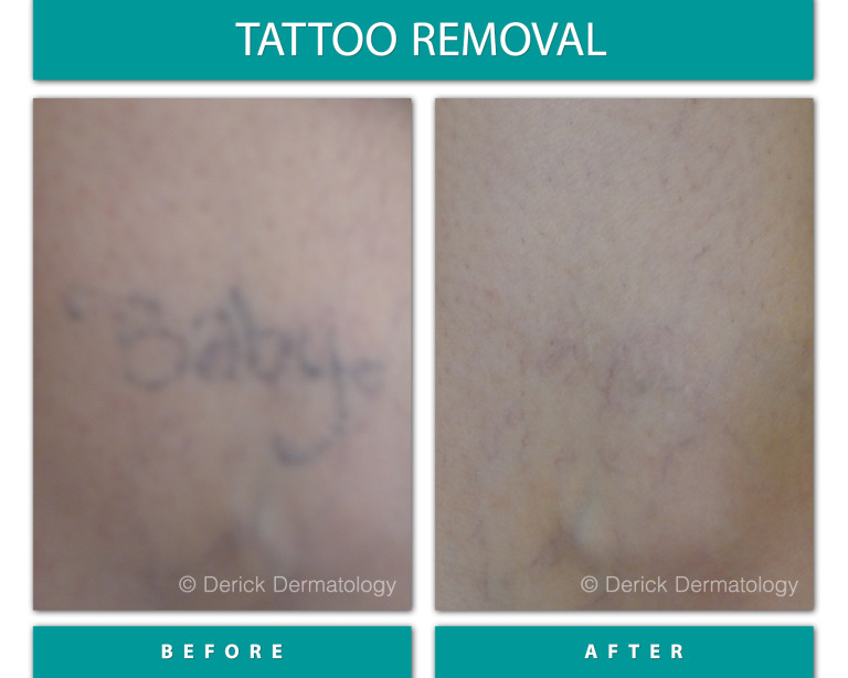 Before and After Image of Tattoo Removal