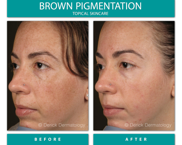 Before and After Image of Brown Pigmentation