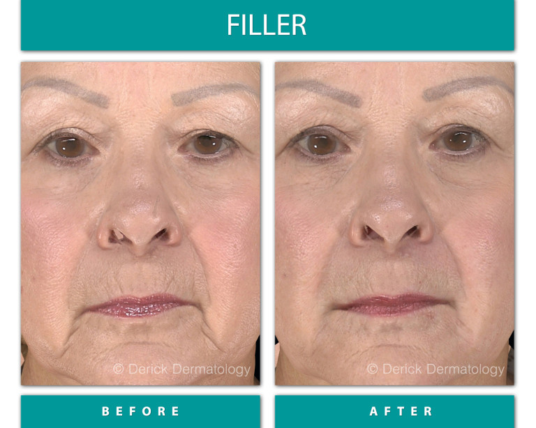 Before and After Image of Filler