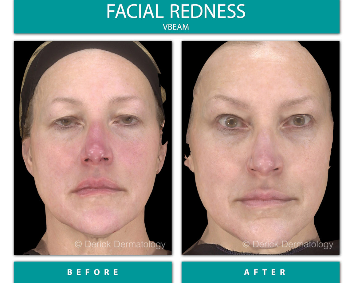 Before & After Gallery Facial Redness VBeam Derick Dermatology