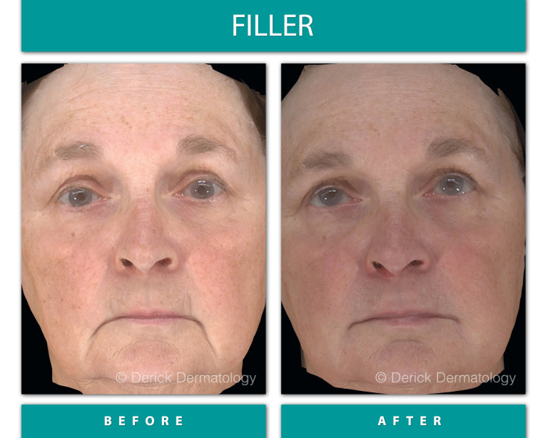 Before and After Image of Filler
