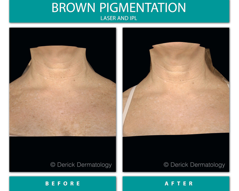 Before and After Image of Brown Pigmentation