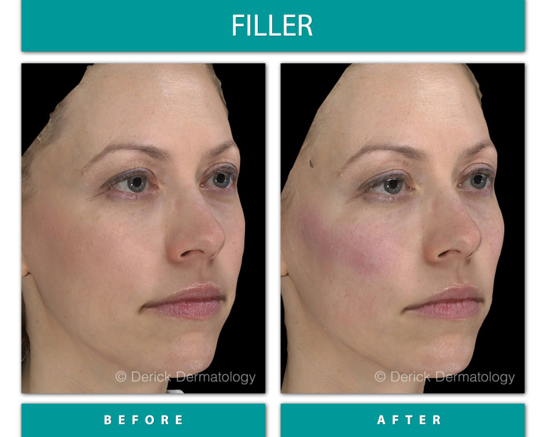 Before and After Image of Filler