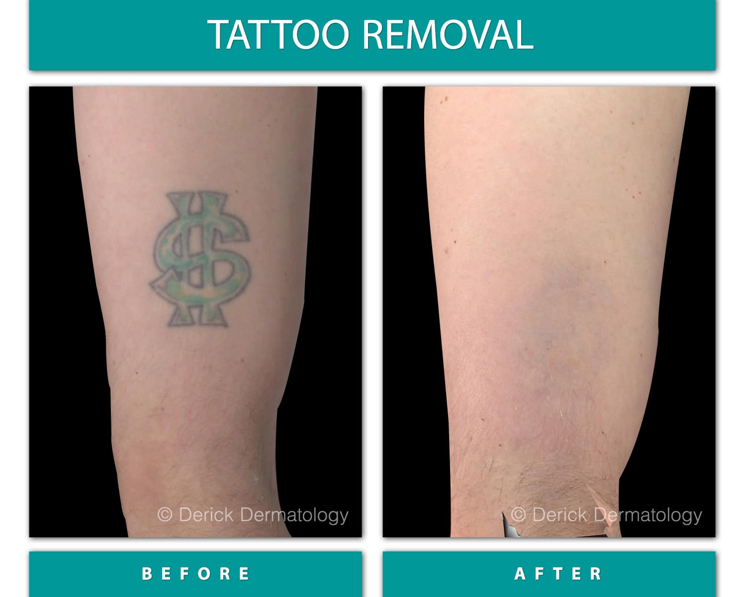 Before and After Image of Tattoo Removal
