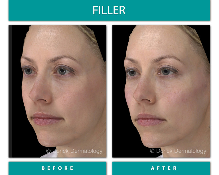 Before and After Image of Filler