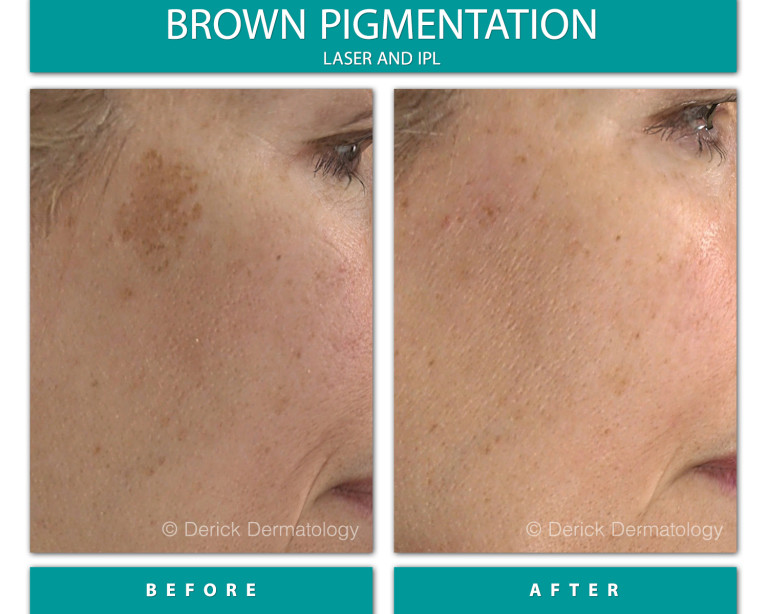 Before and After Image of Brown Pigmentation