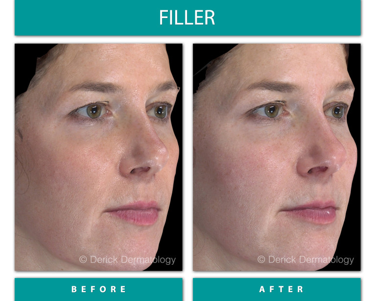 Before and After Image of Filler