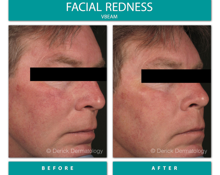 Before and After Image of Facial Redness