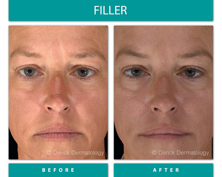 Before and After Image of Filler