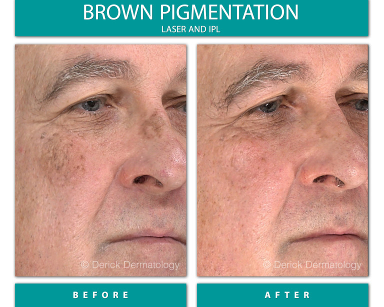 Before and After Image of Brown Pigmentation