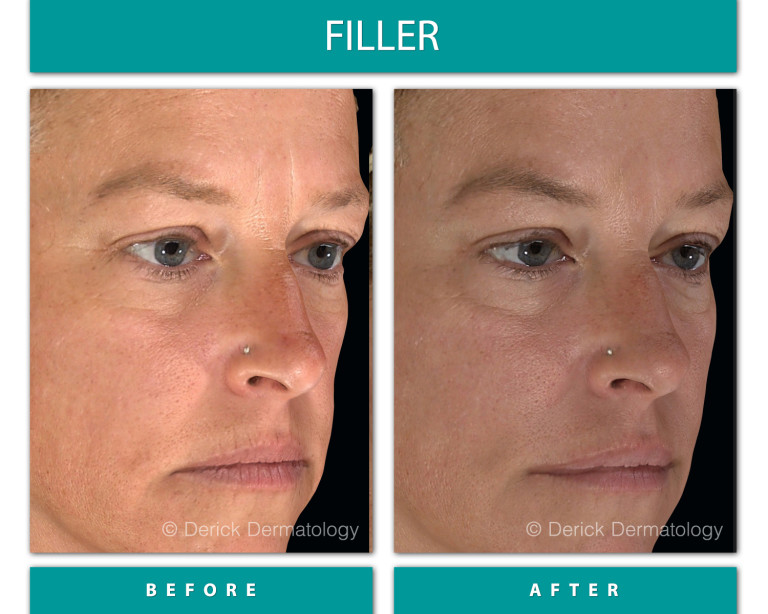 Before and After Image of Filler