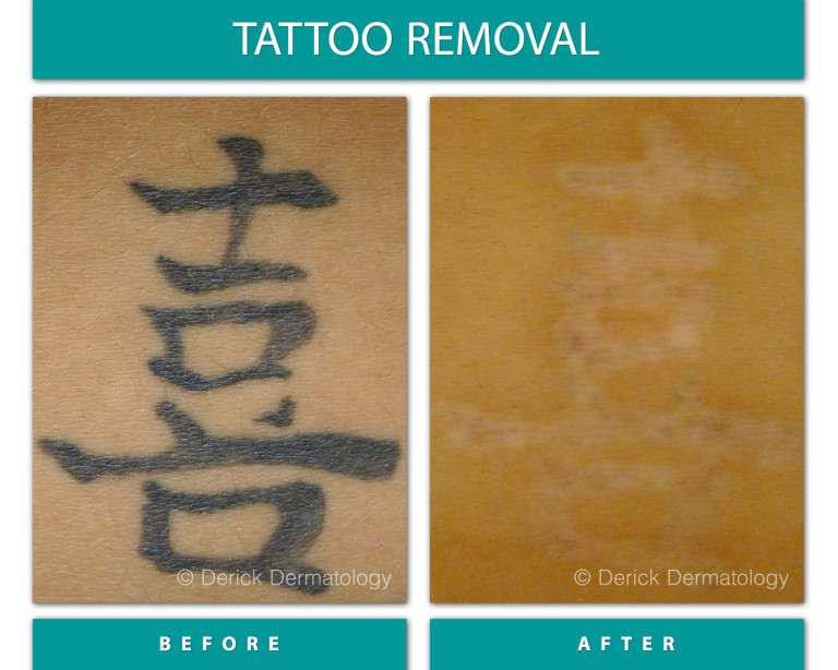 Before and After Image of Tattoo Removal