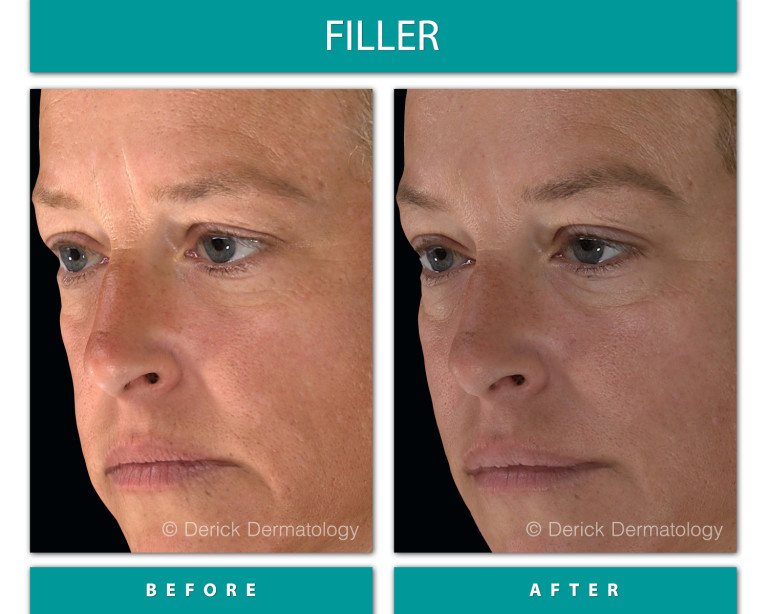 Before and After Image of Filler