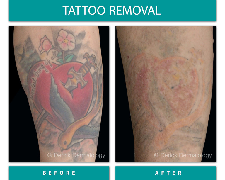 Before and After Image of Tattoo Removal