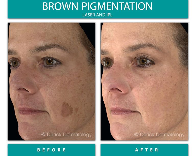 Before and After Image of Brown Pigmentation