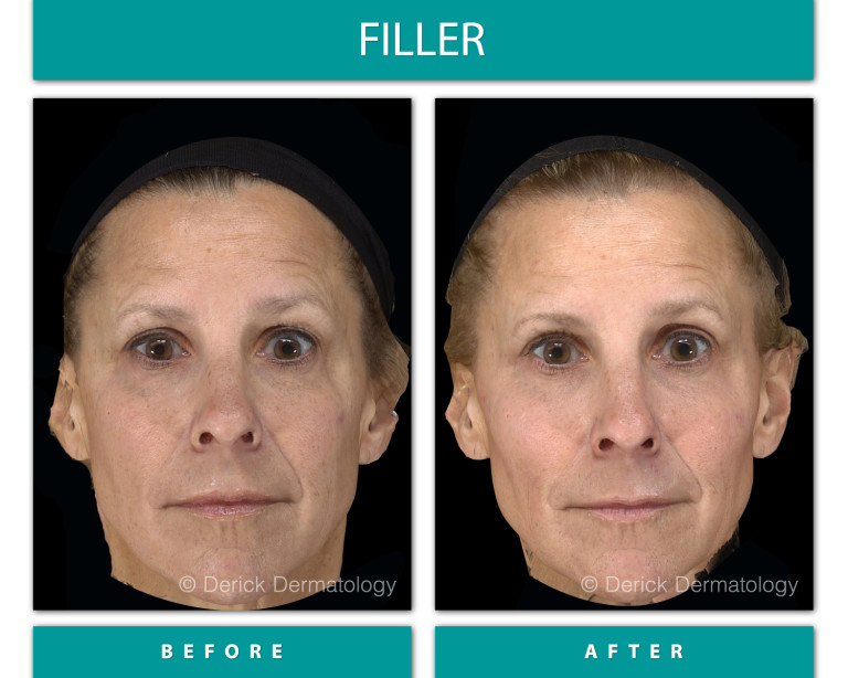 Before and After Image of Filler
