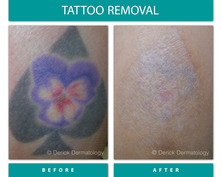 Before and After Image of Tattoo Removal