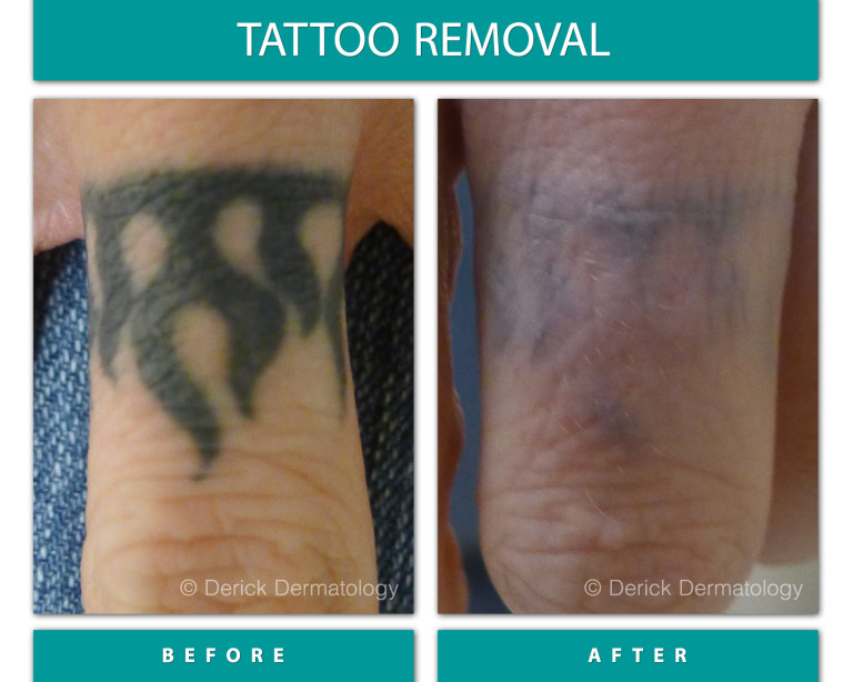 Before and After Image of Tattoo Removal