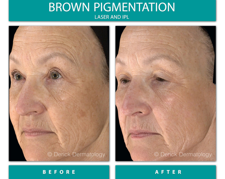 Before and After Image of Brown Pigmentation