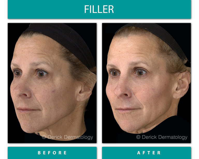 Before and After Image of Filler