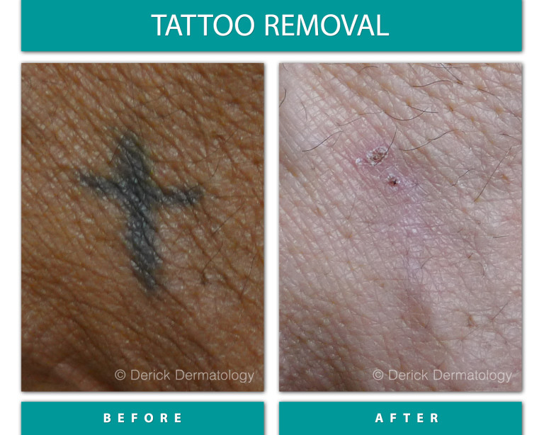 Before and After Image of Tattoo Removal