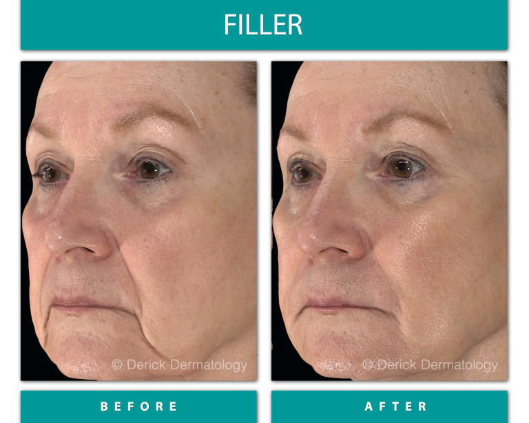 Before and After Image of Filler