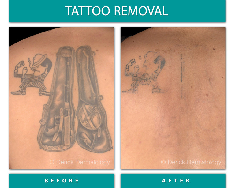 Before and After Image of Tattoo Removal