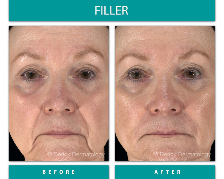 Before and After Image of Filler