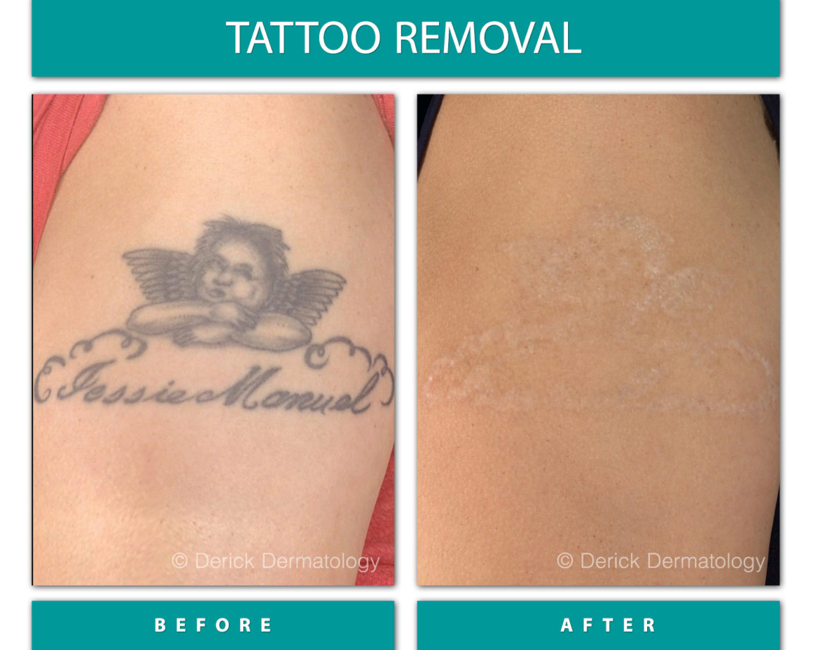 Before & After Gallery Tattoo Removal Derick Dermatology