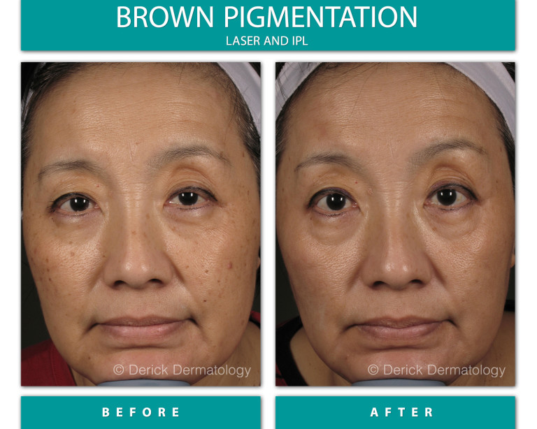 Before and After Image of Brown Pigmentation