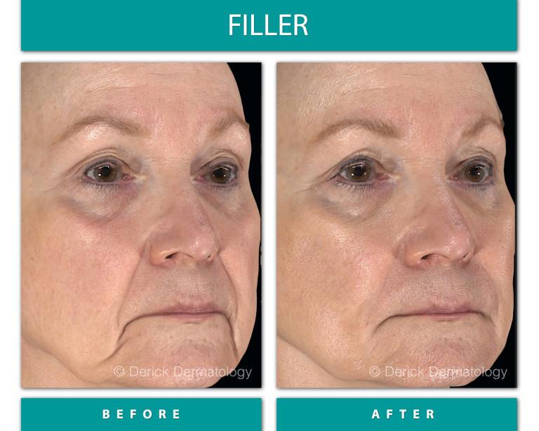 Before and After Image of Filler