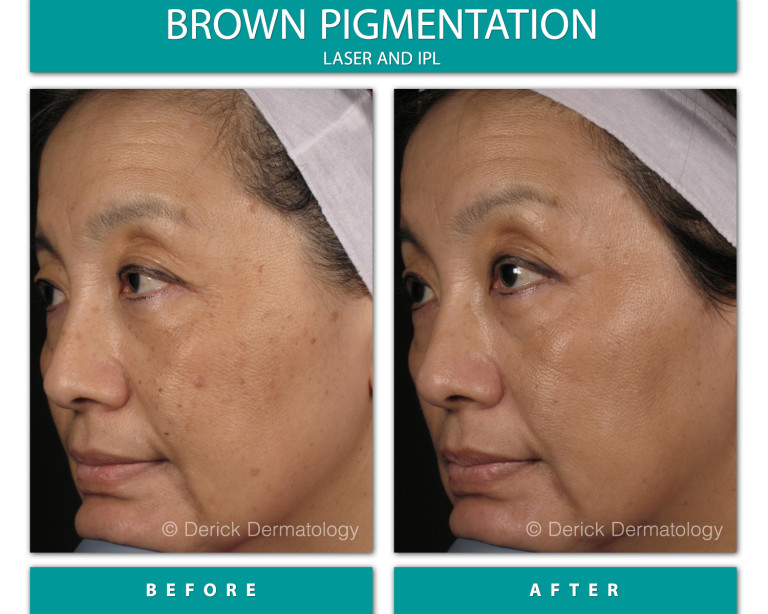 Before and After Image of Brown Pigmentation