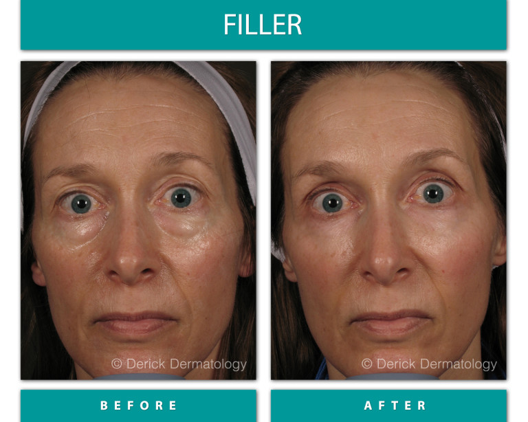 Before and After Image of Filler