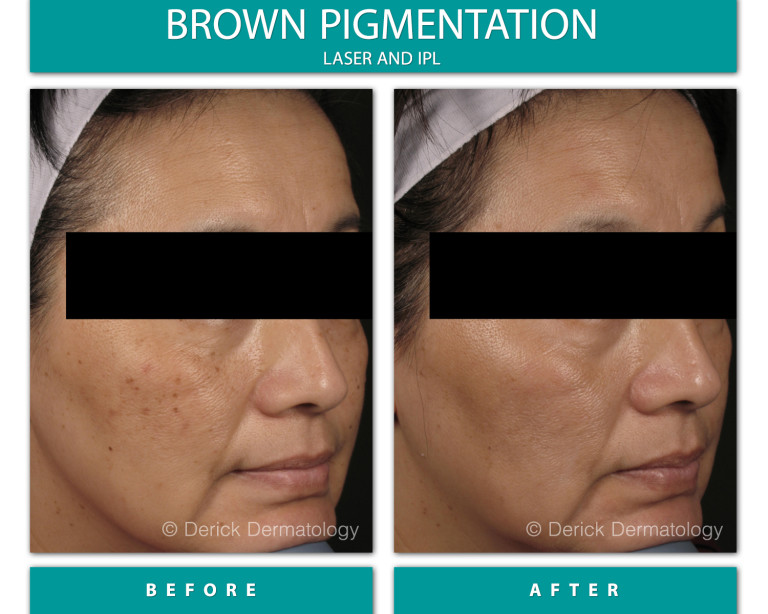 Before and After Image of Brown Pigmentation