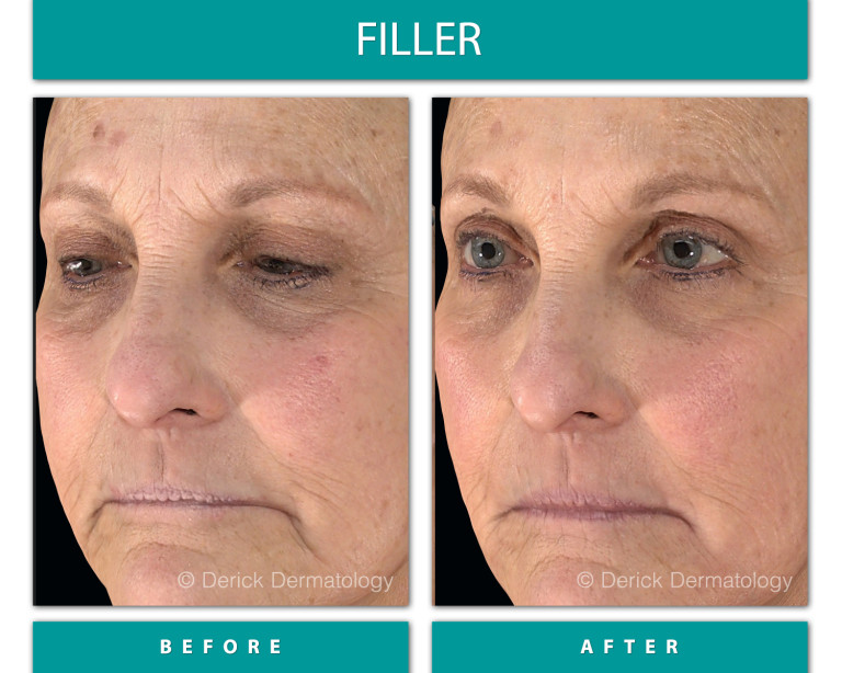 Before and After Image of Filler