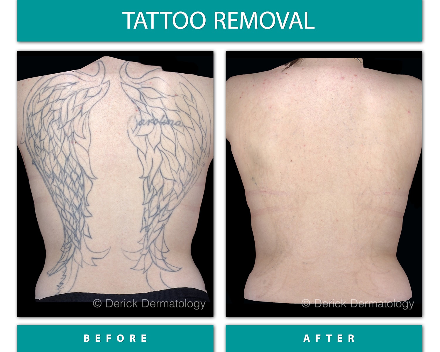 Tattoo Removal Laser Chicago PicoSure Derick Dermatology   22 TATTOO BEFORE AFTER 1500x1200px 