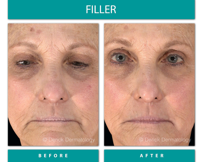 Before and After Image of Filler