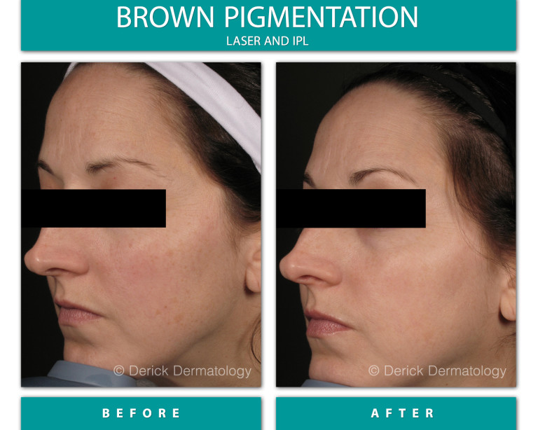 Before and After Image of Brown Pigmentation