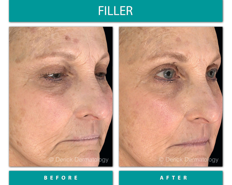 Before and After Image of Filler