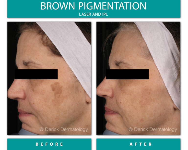 Before and After Image of Brown Pigmentation