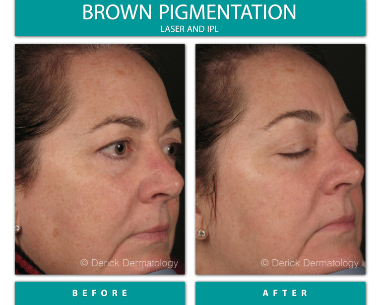 Before and After Image of Brown Pigmentation