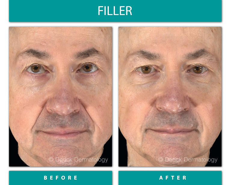 Before and After Image of Filler