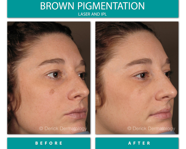 Before and After Image of Brown Pigmentation