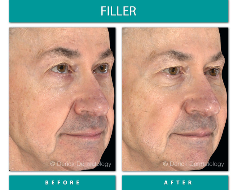 Before and After Image of Filler